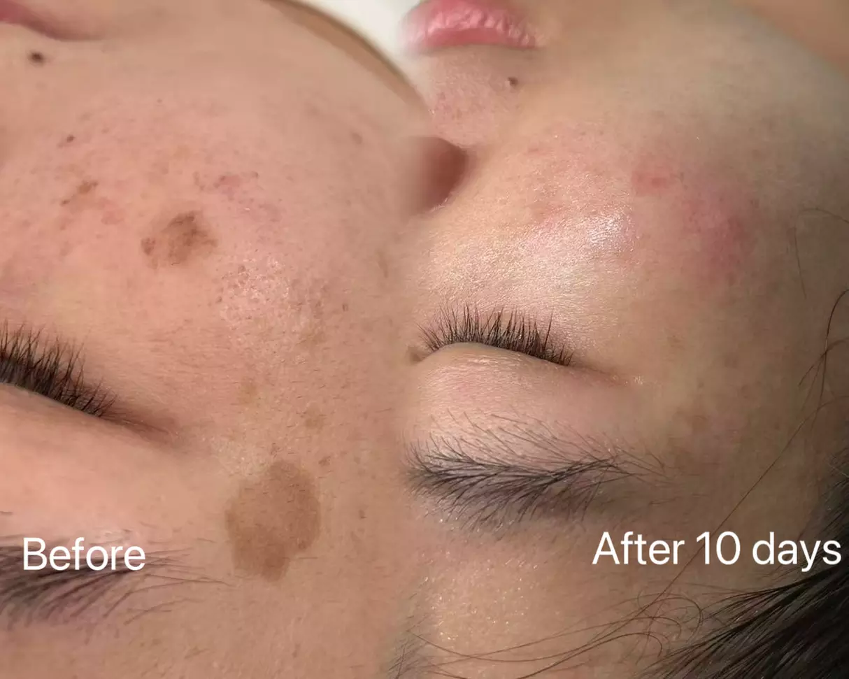 One Pico Laser Session for an Area Up to 0.5" x 0.5" or One or Three Sessions on Up to 1" x 1" ( Up to 80% Off ) - Primary Image