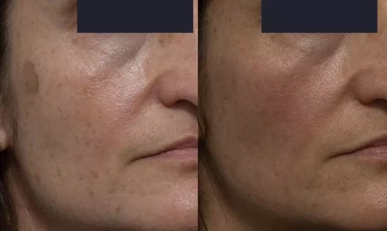 Up to 65% Off PicoWay Resolve Skin Resurfacing Face Treatments