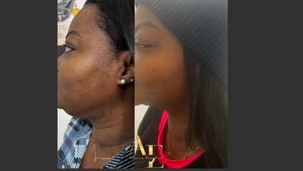 Fat Dissolver Lipo Shot Double Chin 2 ml - Arewa Essential Medspa