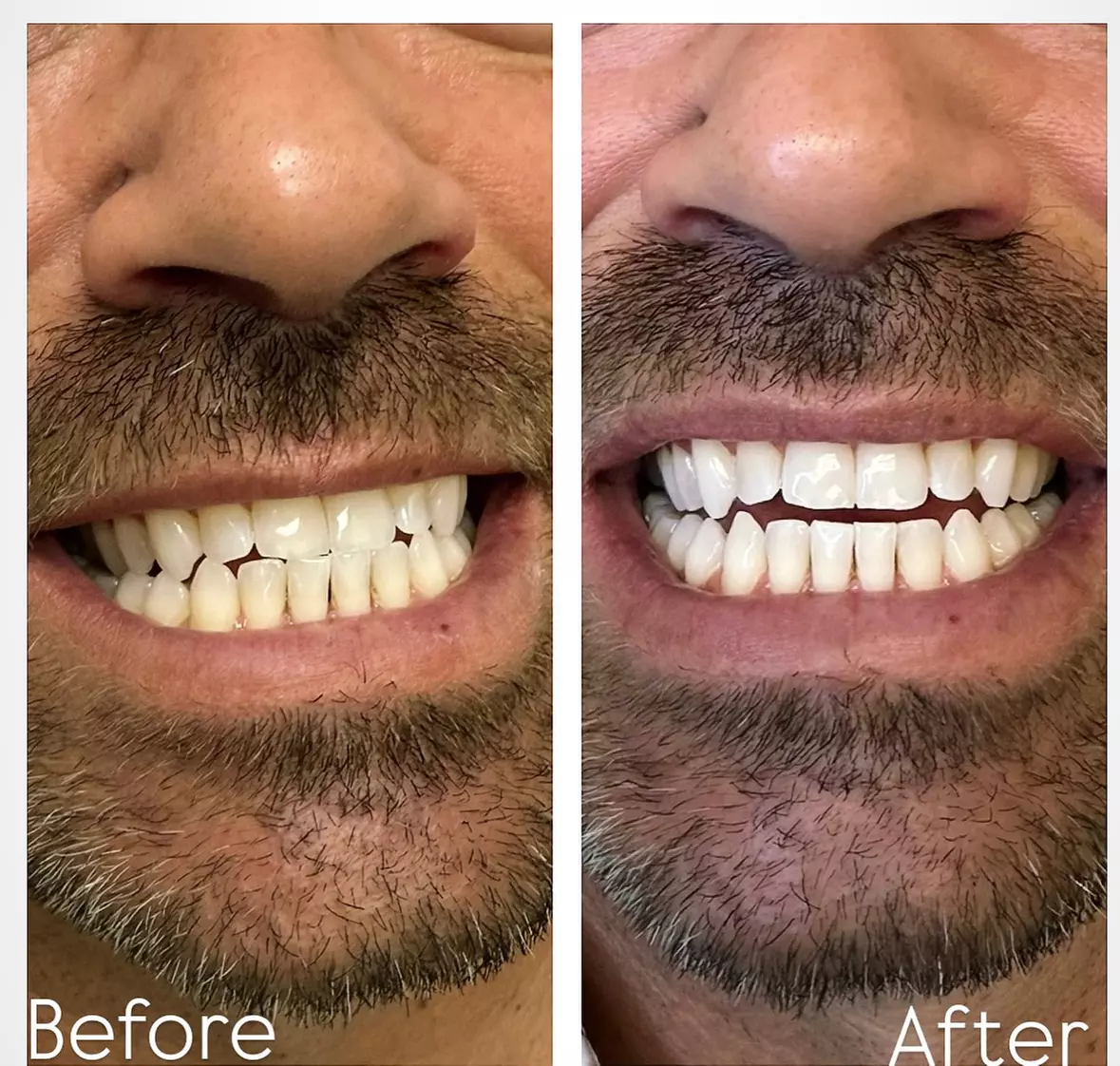 Brighten Your Smile w/ 1 or 2 Beaming White LED Teeth Whitening