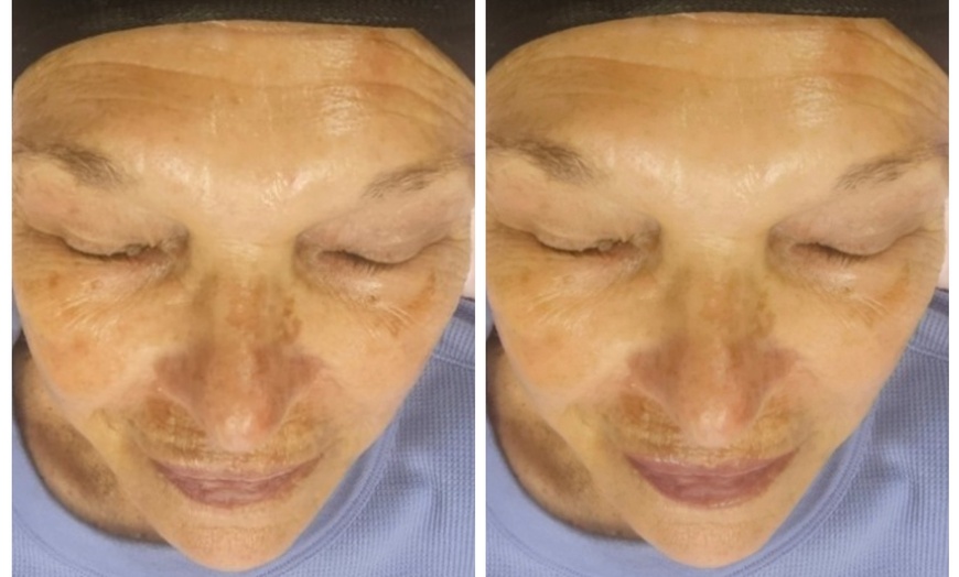 Image 3: Up to 31% Off on HydraFacial at Phoenix Esthetics of CT