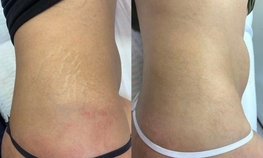 Image 5: Areola Tattoo Treatment, Scalp Micropigmentation Or Cheek Blush Tattoo