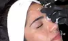 Up to 19% Off on Injection - Botox at Ameze Skin Elements