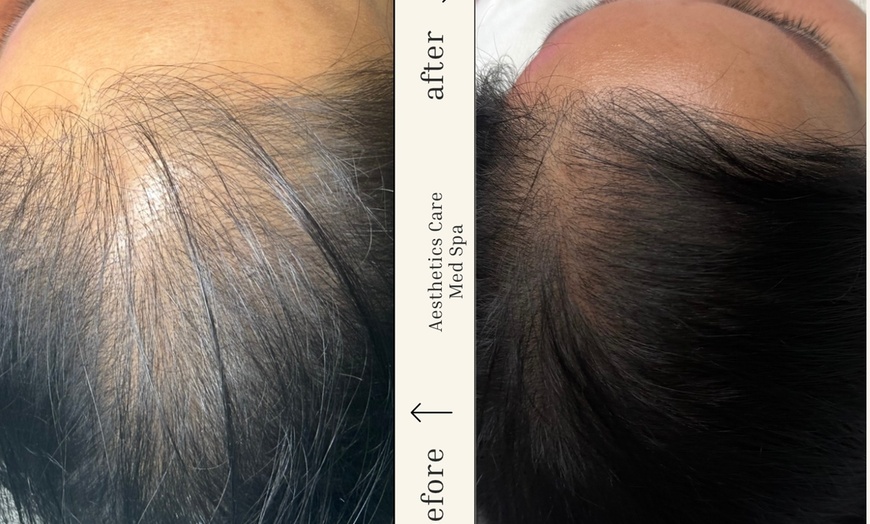 Image 3: Up to 60% Off on Hair Restoration - Non-Surgical at Aesthetics Care Med Spa