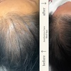 Image 3: Up to 49% Off on Hair Restoration - Non-Surgical at Aesthetics Care Med Spa