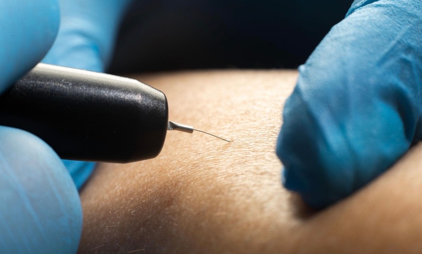 Image 3: 15- or 30-Minute Electrolysis Sessions for Hair Reduction