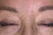 Achieve Ink-Free Skin with Laser by Nicole's Tattoo Removal for All Sizes up to 39% - Second Medium