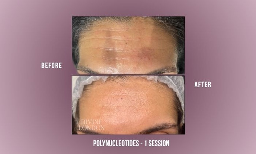 Image 7: Polynucleotides Regenerative Treatment at Divine Aesthetics in London