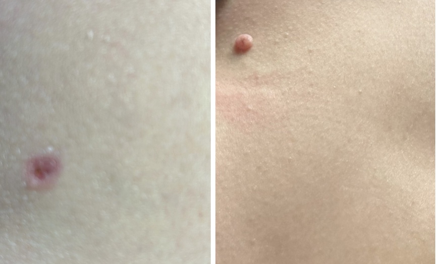 Image 5: Up to Unlimited Skin Tags, Milia, Blood Spot or Mole Wart Removal