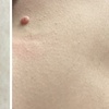 Image 5: Up to Unlimited Skin Tags, Milia, Blood Spot or Mole Wart Removal