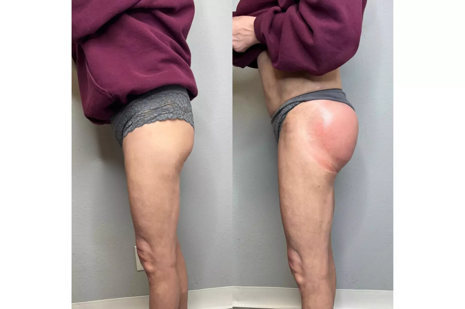 Boost Your Confidence with 30, 60, or 90-Minute Non-Invasive Butt Lift