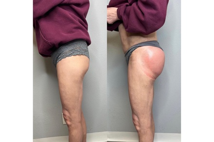 Express Lift - Non-Invasive Butt Lift 30 Min - Blessed Beauty and Skin