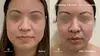 Experience skin lifting and tightening at One Beauty Aesthetics with Ultherapy treatments for chest or neck, up to 60% off