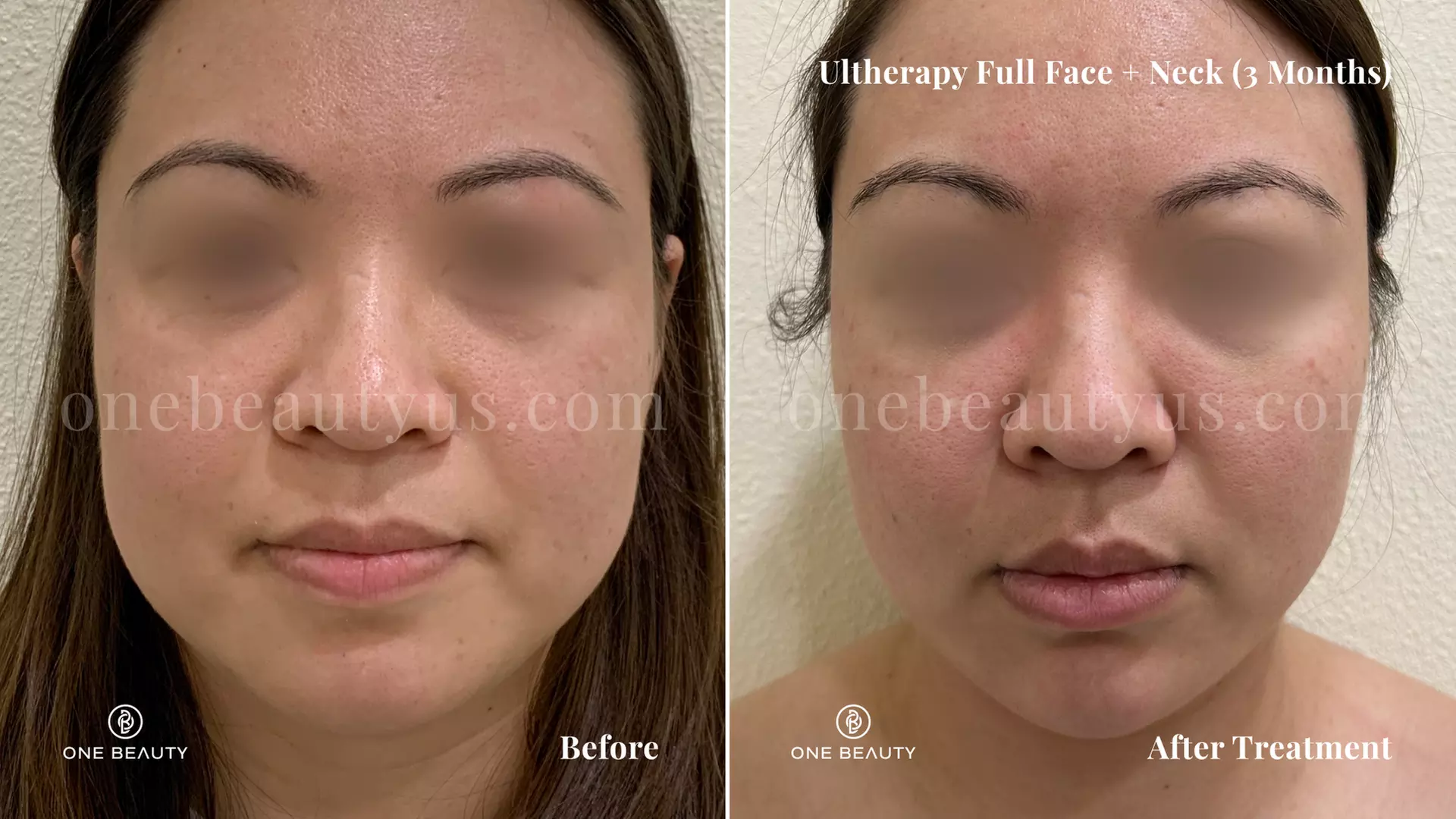 Lift and Tighten Skin with Ultherapy for Chest or Neck