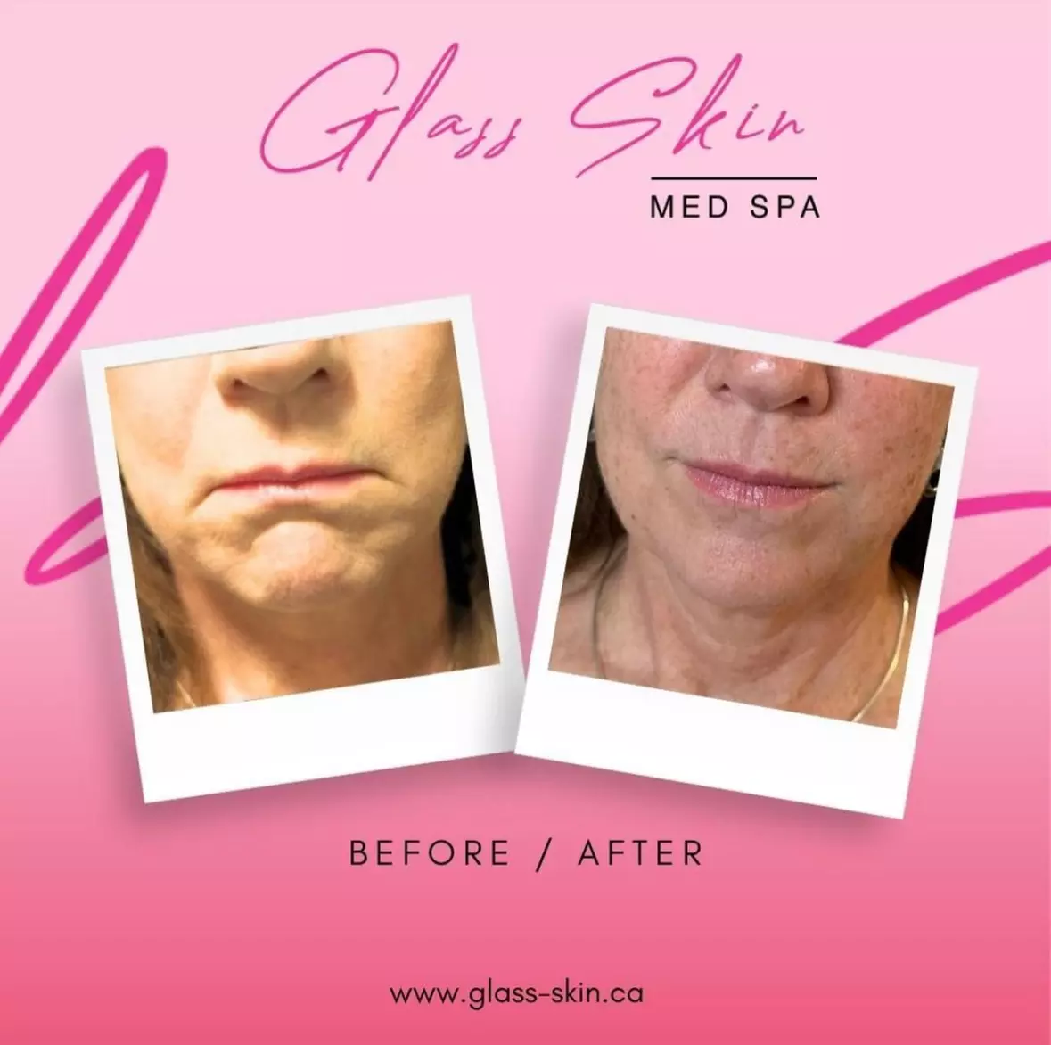 Up to 50% Off on Injection - Botox at Glass Skin Med Spa - Primary Image