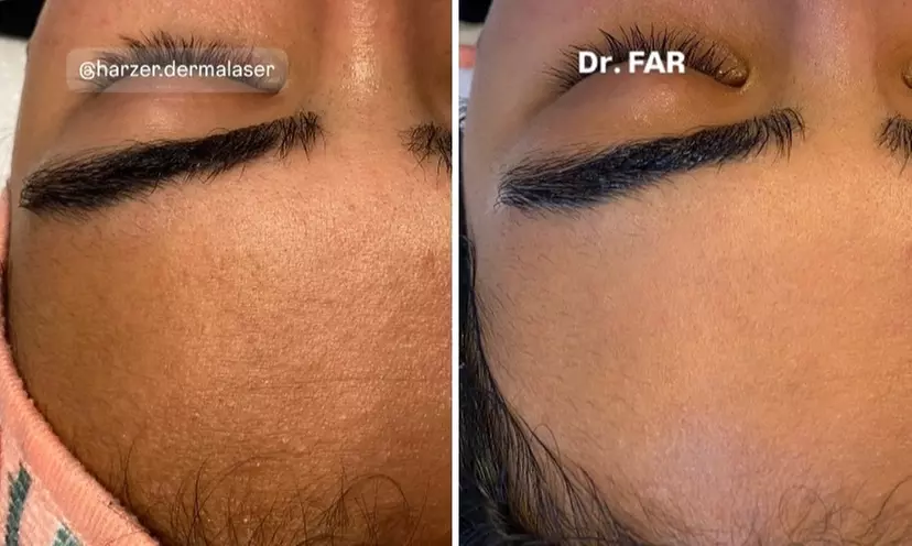 Premium Glow-Facial inkl. Wickeltherapie & MatrixxFace für 1 Person