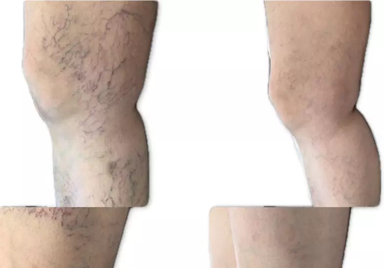 One or Two: Spider Vein Treatments with Complimentary Consultation