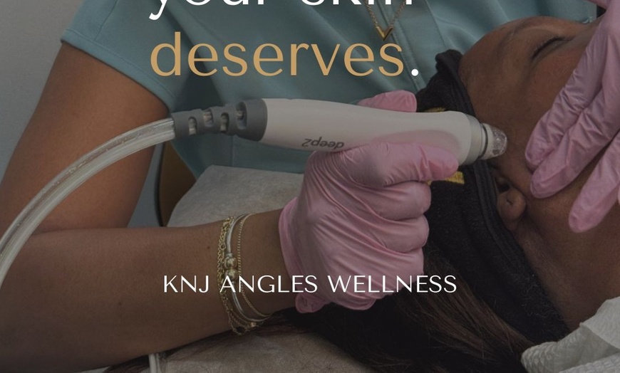 Image 3: Up to 50% Off on Chemical Peel at KNJ ANGLES WELLNESS NP IN Family Health PLLC