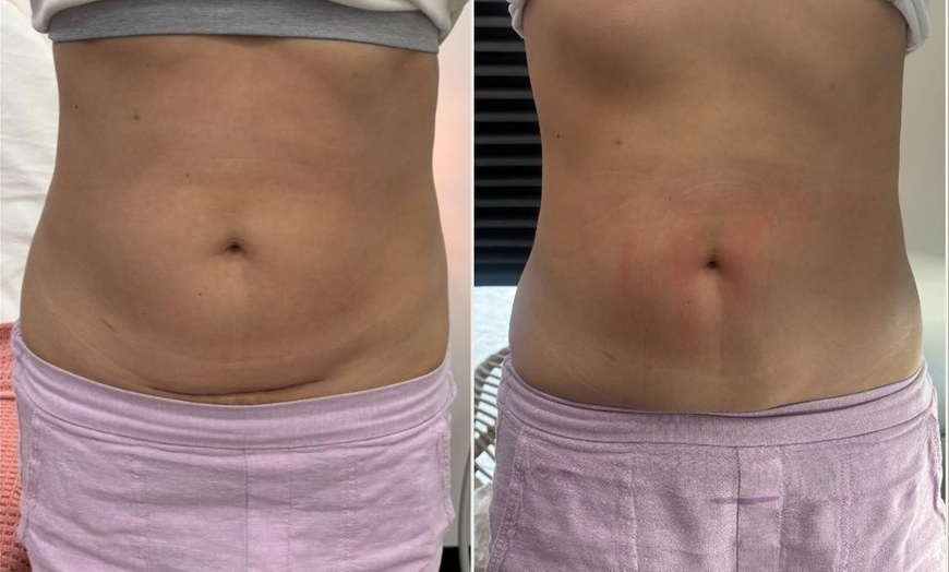 Image 2: Up to 63% Off on Fat Reduction - Non-Branded 
