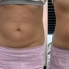 Image 2: Up to 63% Off on Fat Reduction - Non-Branded 