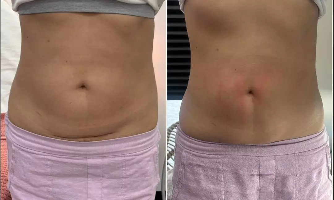 Up to 50% Off on Fat Reduction - Non-Branded at Nutri-Sculpt LLC