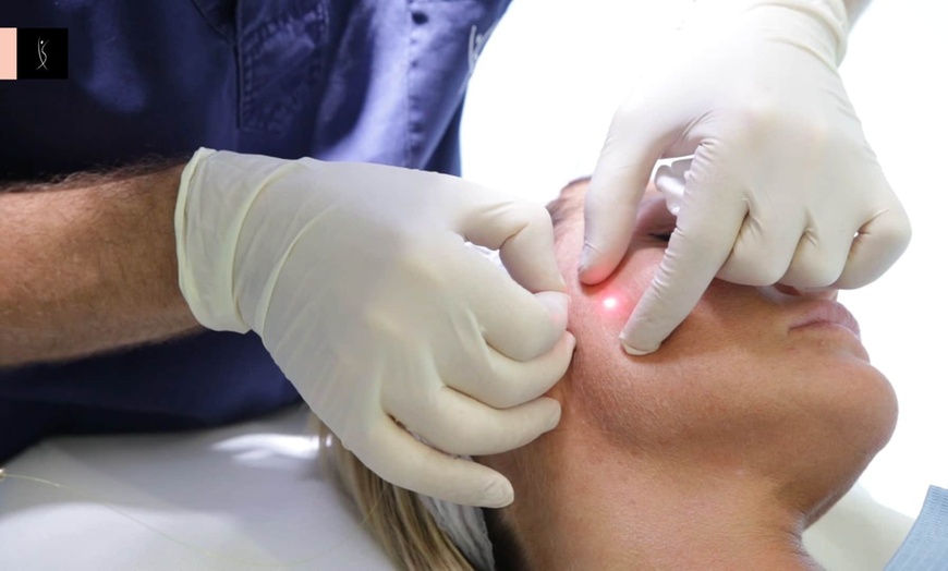 Image 2: Endolifting Laser Treatment for Double Chin