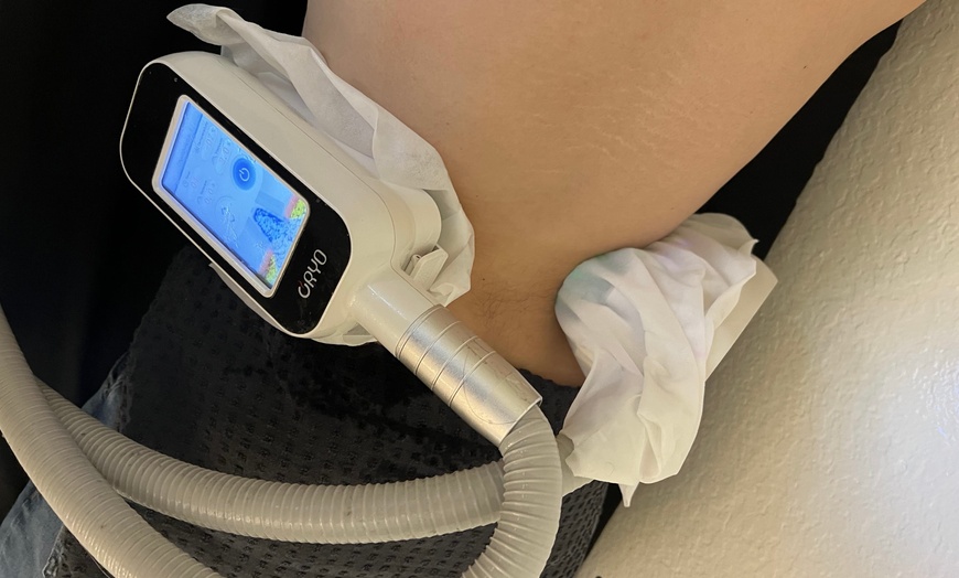 Image 2: Up to 82% Off on Fat Reduction - Non-Branded at L.A. Fat Freeze