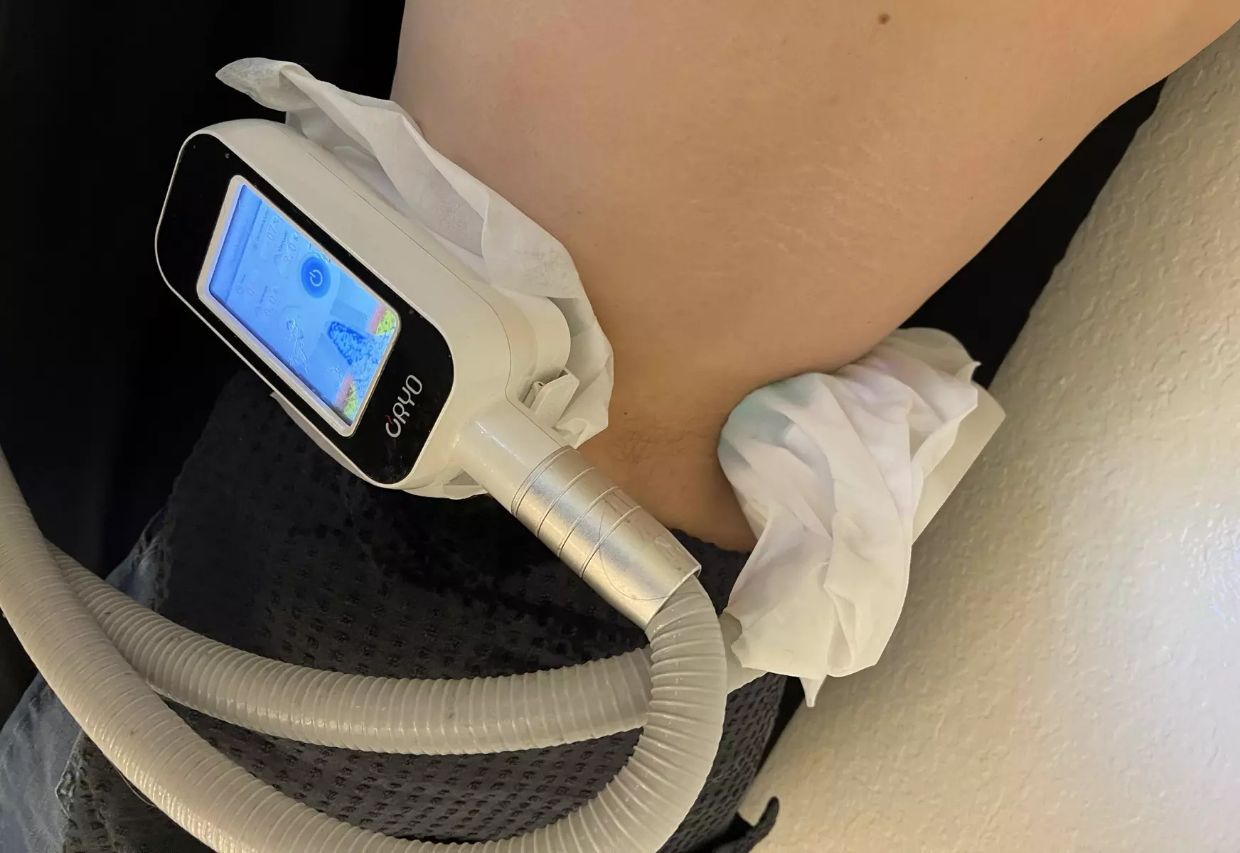 Up to 82% Off on Fat Reduction - Non-Branded at L.A. Fat Freeze