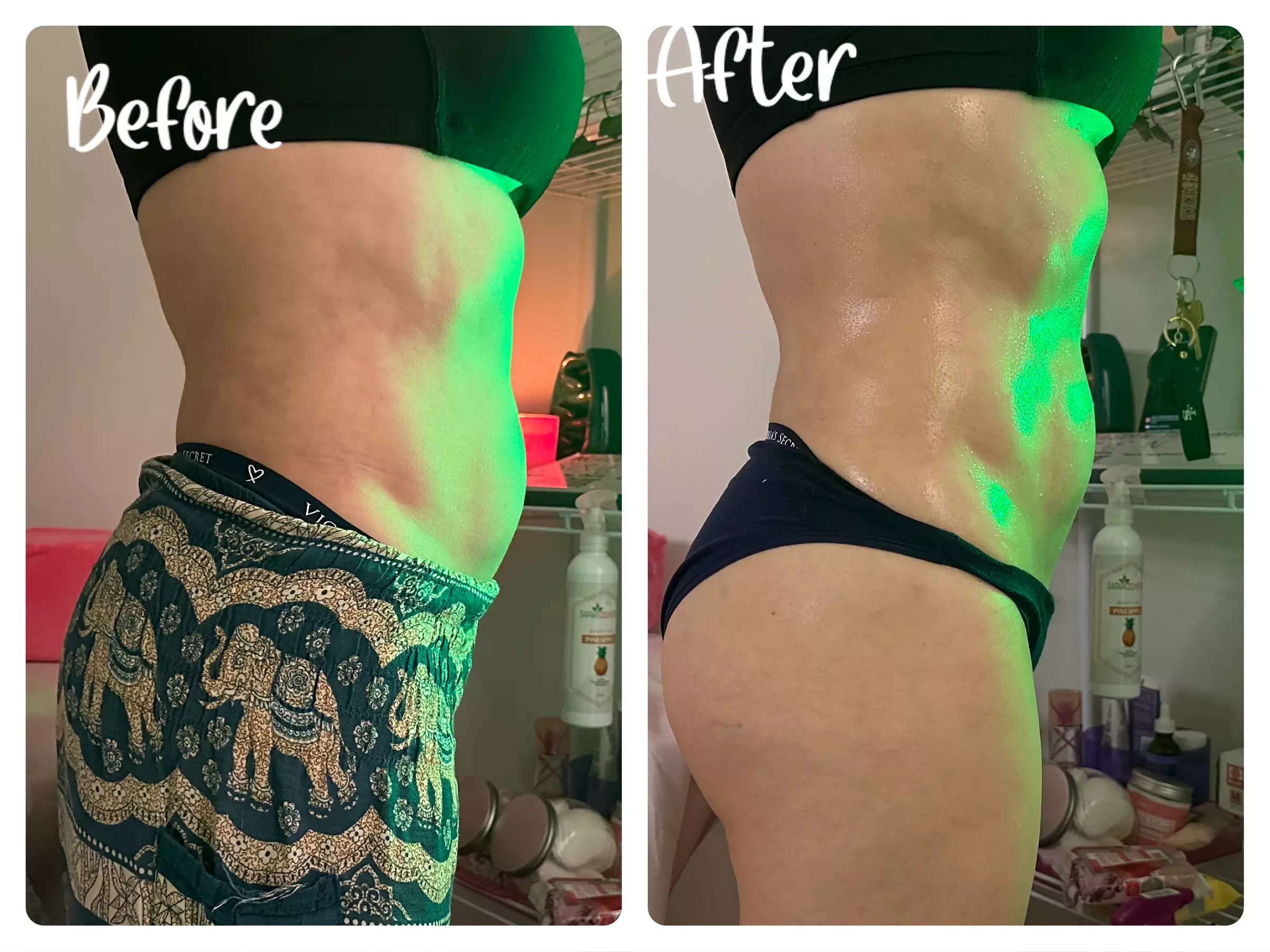 Ultrasonic Body Sculpting Sessions at Dyamond sculpted