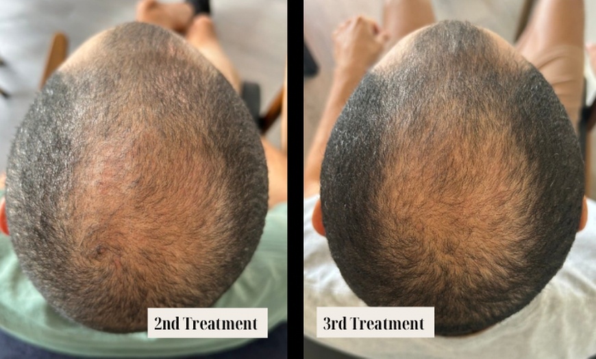 Image 3: Transform Your Hair with One or Three PRP Hair Restoration Sessions
