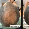 Image 3: Transform Your Hair with One or Three PRP Hair Restoration Sessions