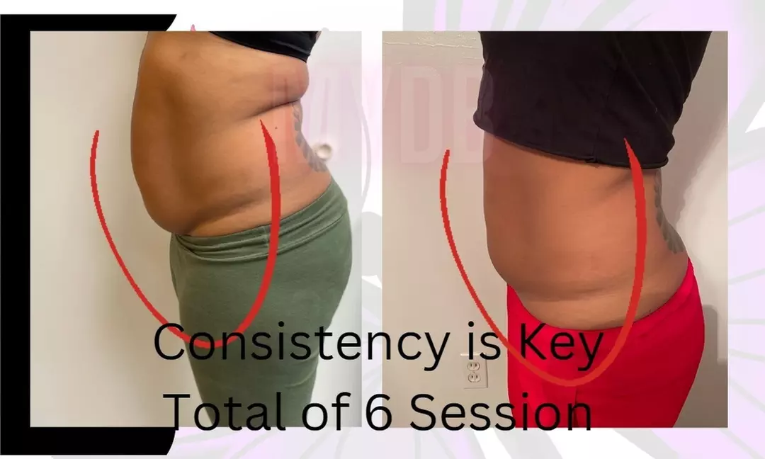 Up to 49% Off on Lipo - Non-Invasive Laser-iLipo at Manifesting Your Divine Body - Primary Image