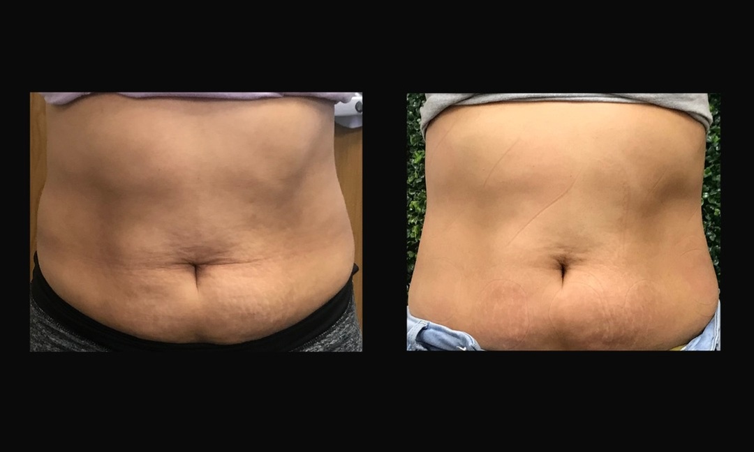 Up to 49% Off on Radio Frequency Skin Tightening at Southern Shapez