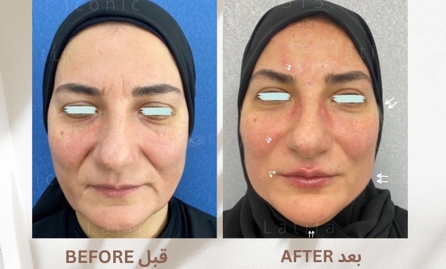 Image 11: Achieve a Natural Look with Dermal Filler 0.5ml, 1ml, or 2ml