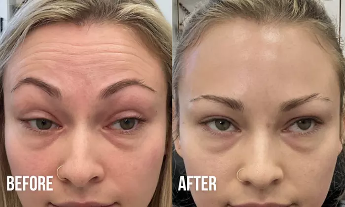 Refreshed Look with 20 or 40 Units of Botox 
