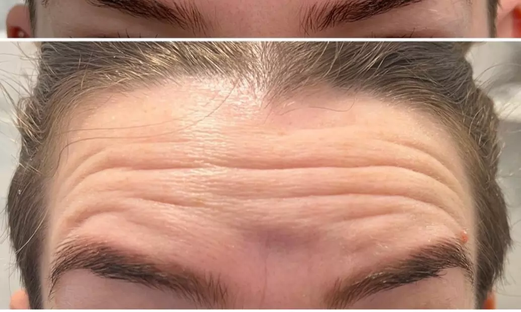 Up to 38% Off on Botox Injections Branded at Biorejuvenate