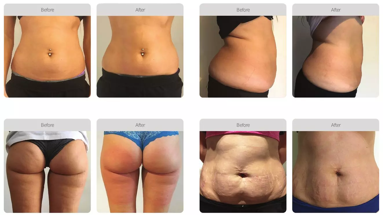 One, Two or Three Body Contouring Sessions (70min each)