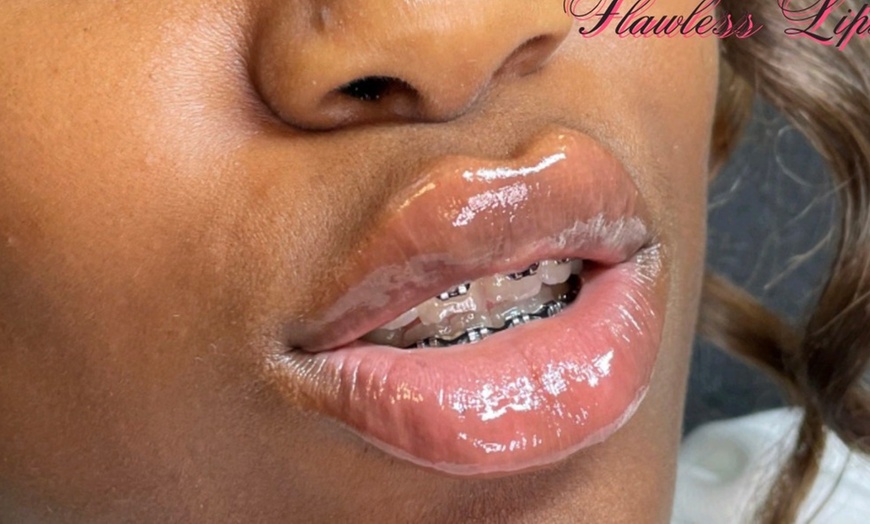 Image 3: Up to 36% Off on Injection - Hyaluronic Acid at Hilenda's Alluring Makeup