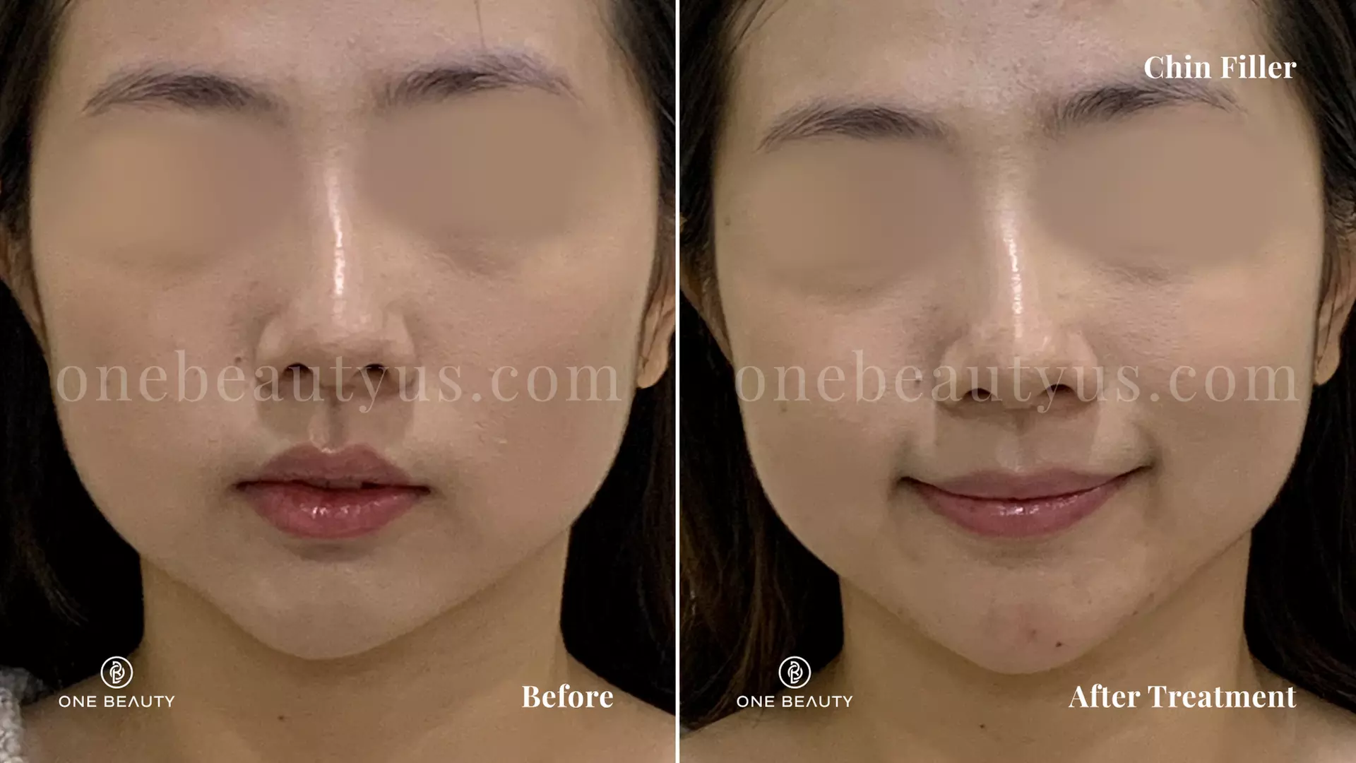 Up to 56% Off on Injection - Voluma at One Beauty Aesthetics