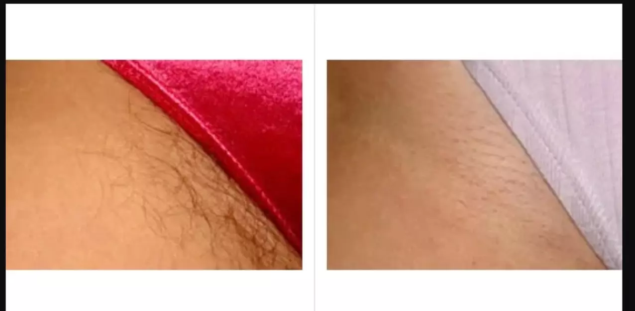 Enjoy Smooth Skin: Underarms or Bikini Laser Hair Removal