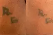 Achieve Ink-Free Skin with Laser by Nicole's Tattoo Removal for All Sizes up to 39% - Second Medium