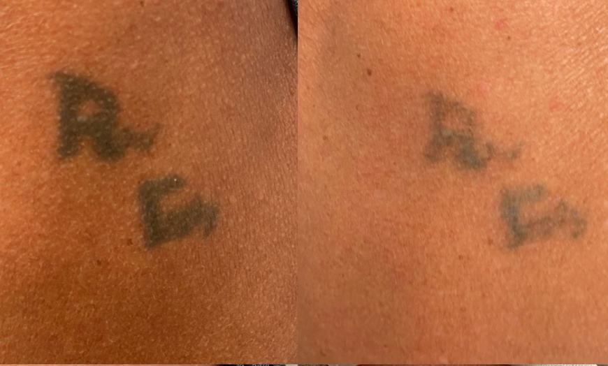 Image 3: Achieve Ink-Free Skin with Laser by Nicole's Tattoo Removal for All Sizes up to 39%