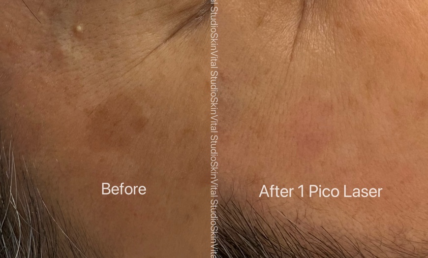 Image 5: Pico Laser Sessions for Small Targeted Areas – 1 or 3 Options 