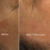 Image 5: Pico Laser Sessions for Small Targeted Areas – 1 or 3 Options 