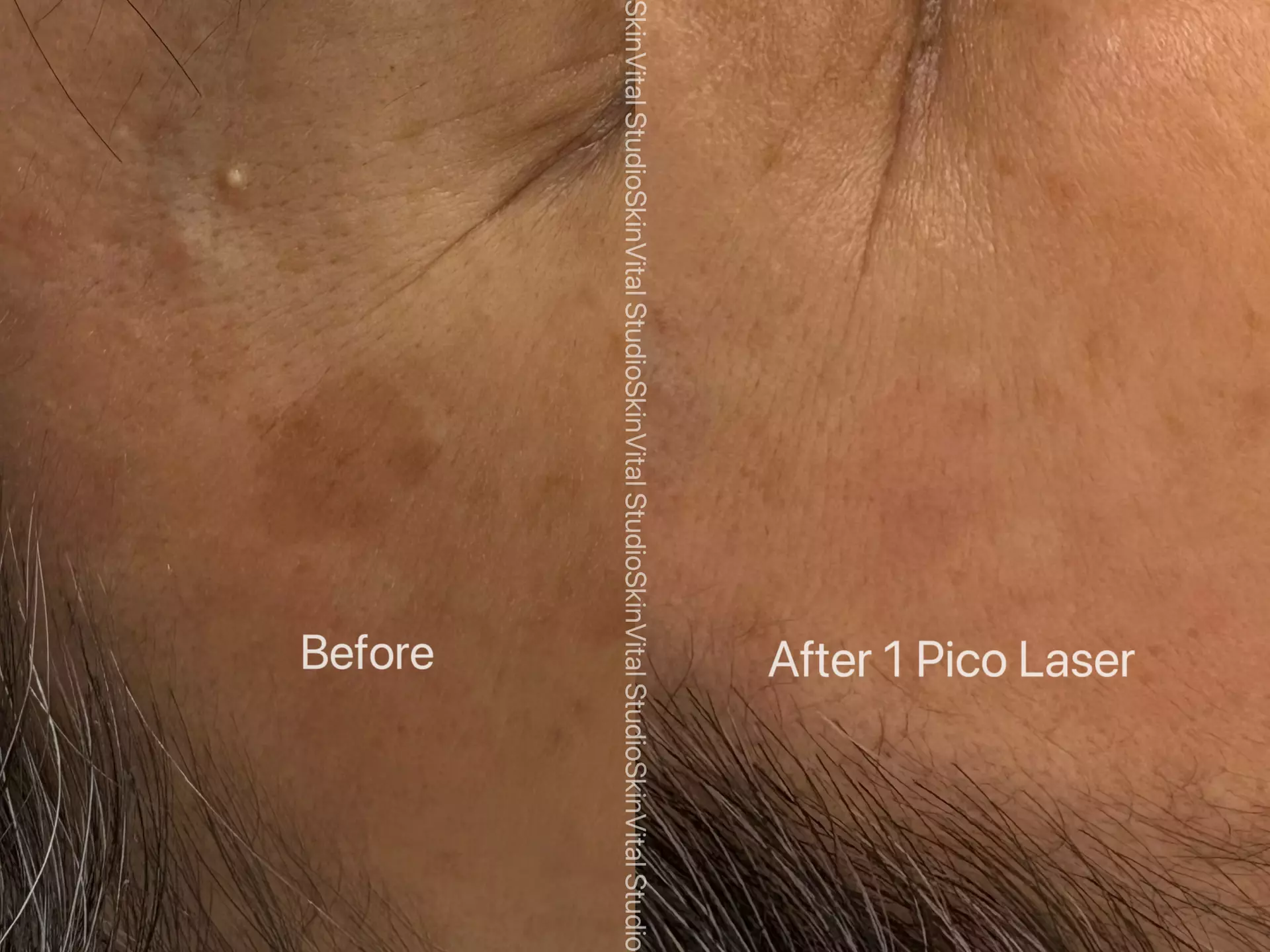 Pico Laser Sessions for Small Targeted Areas – 1 or 3 Options