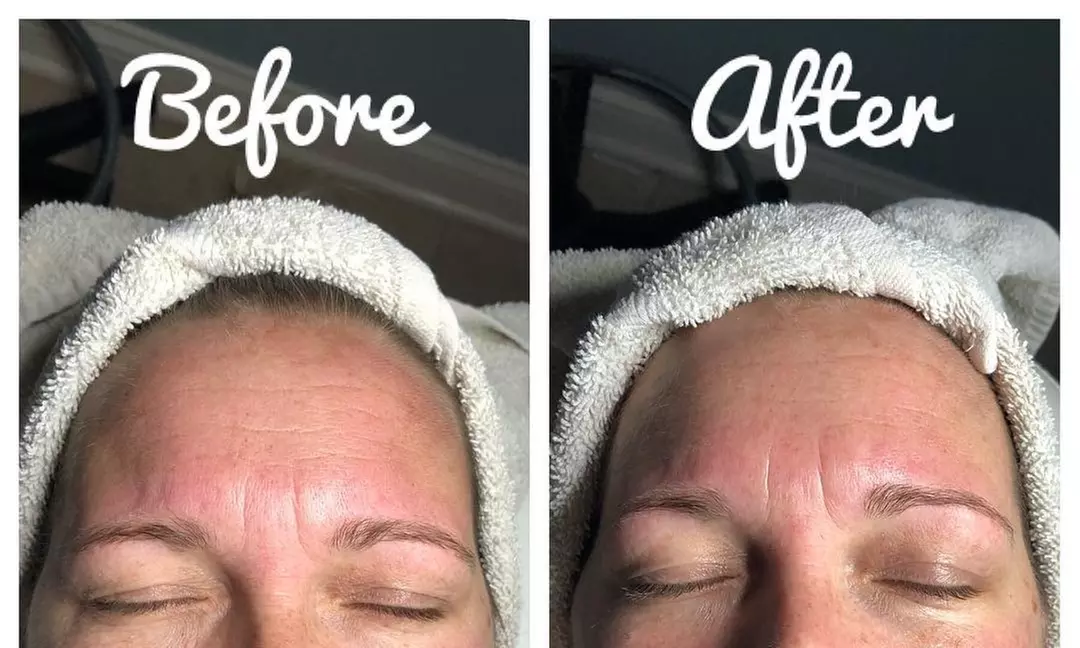 One, Two, or Three HydraFacial Sessions for Glowing Skin