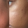 Image 1: Up to 35% Off on Exfoliating Facial at Obsidian Aura Med Spa