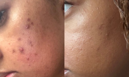 One Dermaplane Facial - Obsidian Aura Med Spa