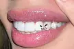 Shine Bright at ALICE BEAUTY SALON RI by Adding One Tooth Gems or a Tooth Gems Butterfly (Up to 36% Off) - Second Medium