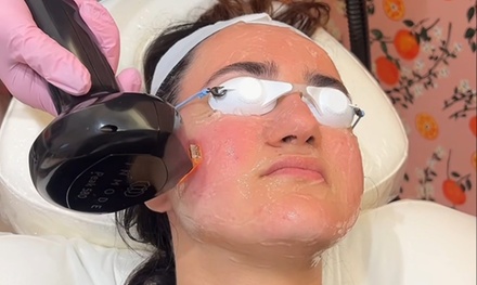 IPL Photo Laser Facial with Lumecca Peak - Naranj Aesthetics